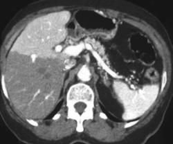 Flow Changes Due to Central Vessel Obstruction - CTisus CT Scan