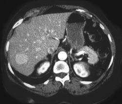 Focal Nodular Hyperplasia (FNH) - CTisus CT Scan