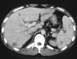 Aspergillosis Involving Both the Liver and Spleen - CTisus CT Scan