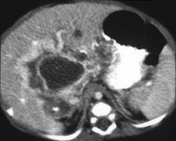 Hemangioendothelioma - CTisus CT Scan