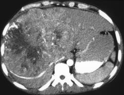 Hepatoma - CTisus CT Scan