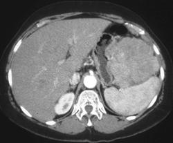 Hepatoma Simulates A Gastric Leiomyosarcoma - CTisus CT Scan