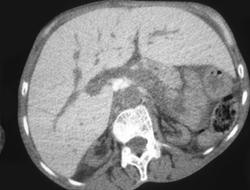 Dense Liver Due to Sickle Cell Disease - CTisus CT Scan