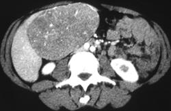 Focal Nodular Hyperplasia (FNH) (atypical) - CTisus CT Scan