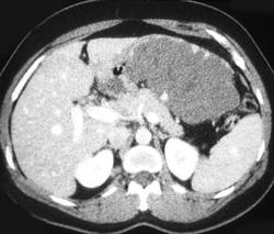 Giant Cavernous Hemangioma - CTisus CT Scan