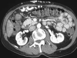 Cirrhosis of the Liver With Large Umbilical Vein Varices - CTisus CT Scan