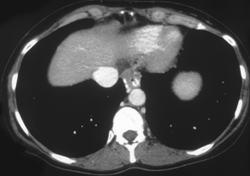 Esophageal Varices - CTisus CT Scan