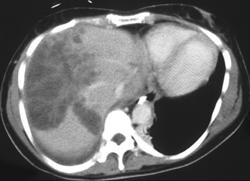 Liver Following Cryosurgery - CTisus CT Scan