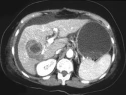 Liver Lesion Following Cryosurgery - CTisus CT Scan