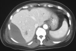 Subcapsular Hematoma Following Liver Biopsy - CTisus CT Scan