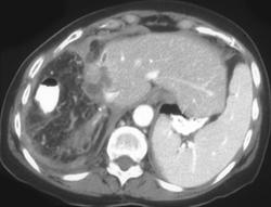 Omentum Placed in Bed of Right Hepatic Resection (normal Appearance) - CTisus CT Scan