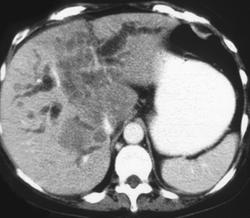 Cholangiocarcinoma With Satellite Lesions - CTisus CT Scan