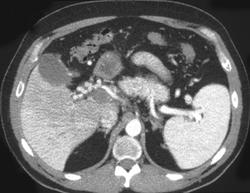 Portal Vein Thrombosis Simulates Dilated Common Bile Duct (CBD) - CTisus CT Scan