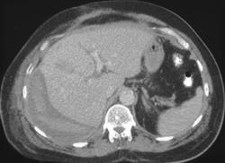 Subcapsular Bleed - CTisus CT Scan