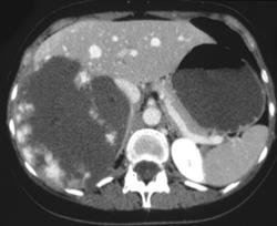 Giant Cavernous Hemangioma - CTisus CT Scan