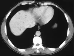 Candidiasis of the Liver - CTisus CT Scan