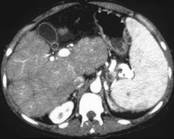 Dual Phase Appearance of Cirrhosis of the Liver - CTisus CT Scan