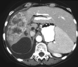 Cholangiocarcinoma of the Liver - CTisus CT Scan