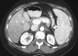 Thrombosis of Right Branch of Intrahepatic Portal Vein - CTisus CT Scan