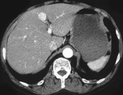 Hepatic Artery Pseudoaneurysm - CTisus CT Scan