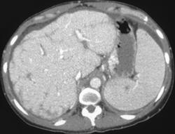 Dual Phase Appearance of Cirrhosis - CTisus CT Scan