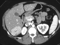 Focal Nodular Hyperplasia With Lesion Seen Only on Arterial Phase Imaging - CTisus CT Scan