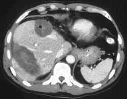 Several Sites of Cryosurgery in the Liver - CTisus CT Scan