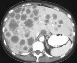 Hepatic Metastases Due to Melanoma - CTisus CT Scan