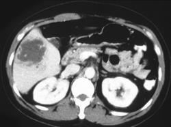 Liver Abscess Due to E.coli - CTisus CT Scan