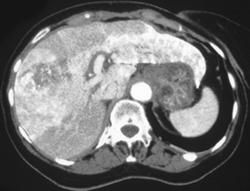 Unusual Metastatic Colon Cancer - CTisus CT Scan