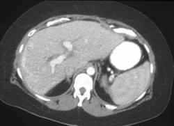 Peripheral Calcifications in the Liver Due to Prior Infarcts.  This Liver Was A Transplant. - CTisus CT Scan