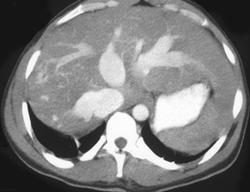 Huge Hepatic Veins Due to Congestive Heart Failure - CTisus CT Scan