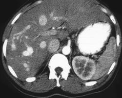 Dilated IVC and Hepatic Veins in Patient With Right Heart Failure - CTisus CT Scan