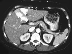 Hot Spot Liver Due to SVC Syndrome - CTisus CT Scan