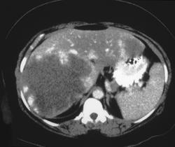 Giant Cavernous Hemangioma - CTisus CT Scan