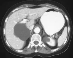 Hepatic Cyst - CTisus CT Scan