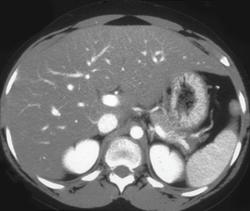 Fatty Infiltration of the Liver - CTisus CT Scan