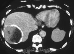 Hydatid Disease of the Liver - CTisus CT Scan