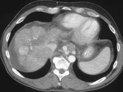 Hepatoma in A Cirrhotic Liver - CTisus CT Scan