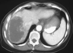 Cholangiocarcinoma - CTisus CT Scan