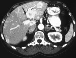 Islet Cell Tumor of the Pancreas Metastatic to the Liver - CTisus CT Scan