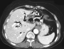 Oriental Cholangitis With Stones in the Biliary Tree - CTisus CT Scan