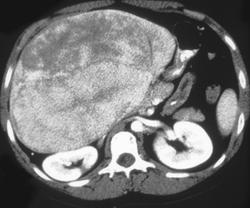 Hepatoma - CTisus CT Scan