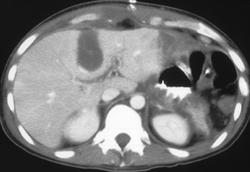 Typical Tear Drop Shape Following Cryosurgery - CTisus CT Scan