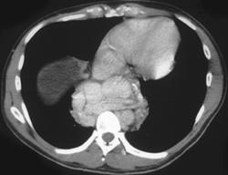 Esophageal Varices Due to Cirrhosis - CTisus CT Scan