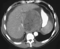 Hepatoma - CTisus CT Scan