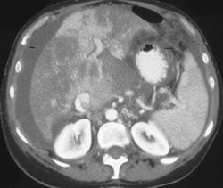 Budd-chiari Syndrome - CTisus CT Scan