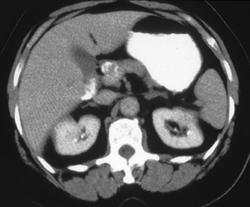 Calcified Hepatic Artery Aneurysm - CTisus CT Scan