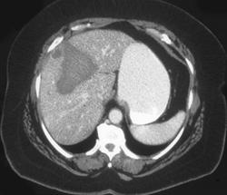 Liver Bleed Following Biopsy - CTisus CT Scan