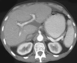 Periportal Edema - Liver Case Studies - CTisus CT Scanning